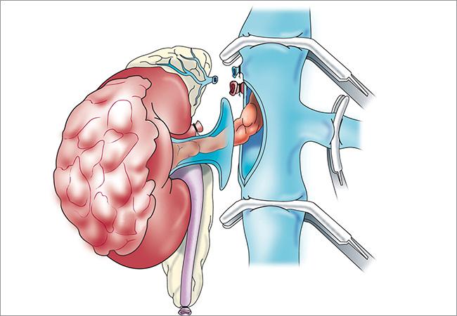 Radical Nephrectomy